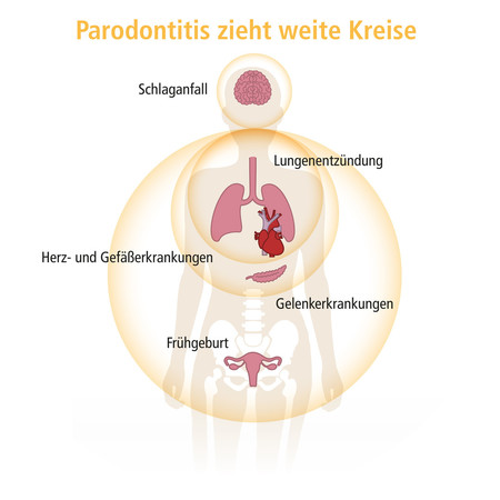 parodontitis-zieht-weite-kreise_quadratisch_header-003
