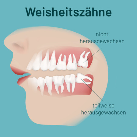 weisheitszaehne-002