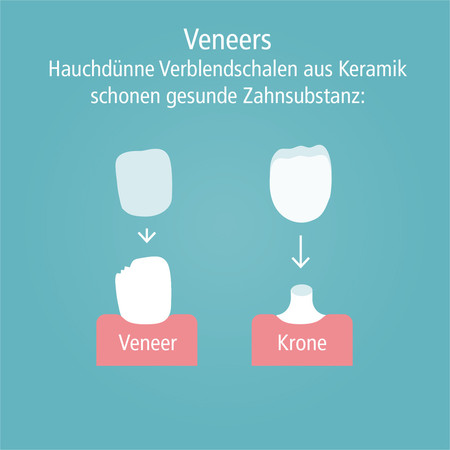 veneers-002