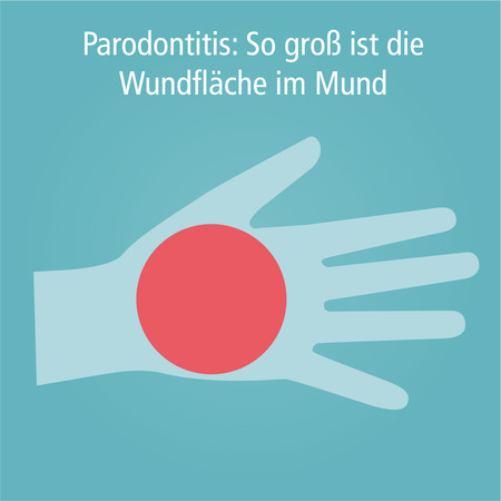 Parodontitis_Wundflaeche-002